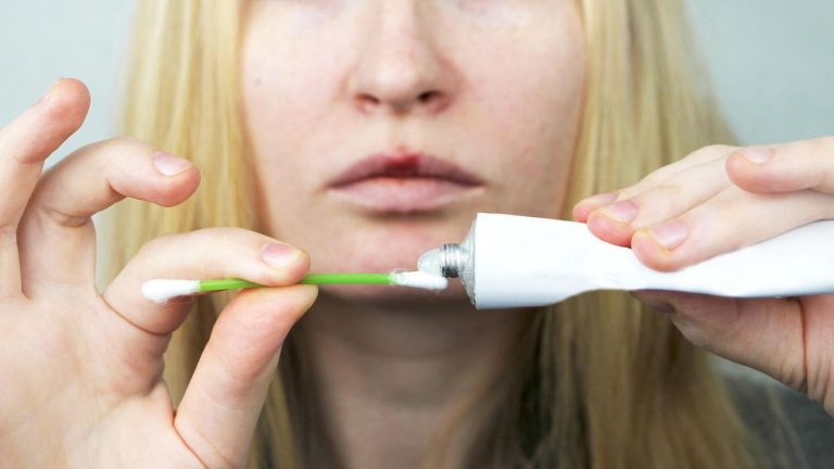 Lippenbläschen: Herpes-Creme im Vergleich: Diese Produkte sollen typische Symptome lindern